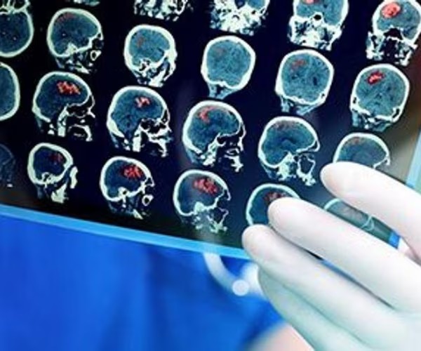 Image in @MarioNawfal's post: 🚨 JUST IN: SCANS SHOW BRAIN CHANGES IN PEOPLE WITH LONG COVID
A brain scan study reveals distinct …